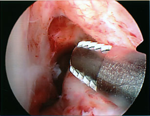 A hollow cavity where a ligament should be