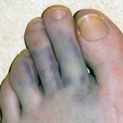 The blue completely encircles her toes