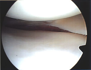 The torn cartilage is on the left of this photo, in the crack